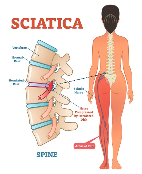 Osteopata Torino Nervo sciatico